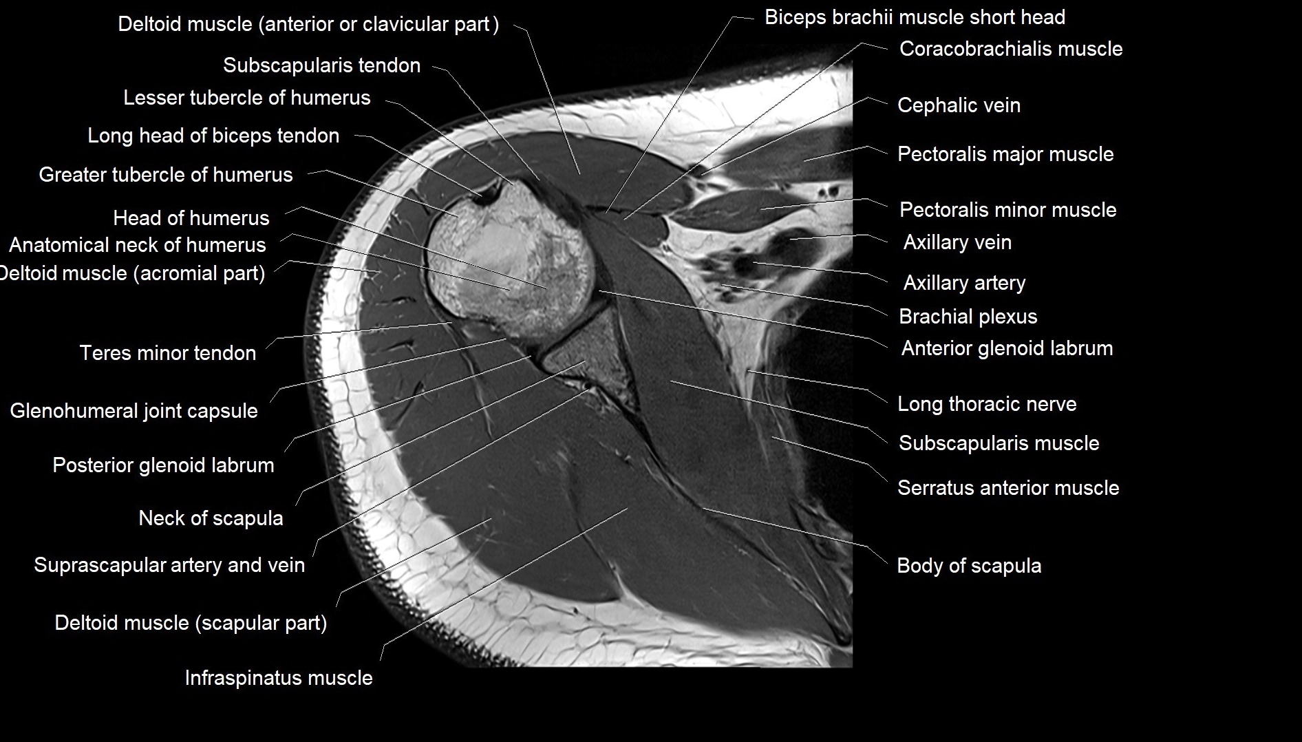 Shoulder cross sectional anatomy MRI 3T axial image 21.webp